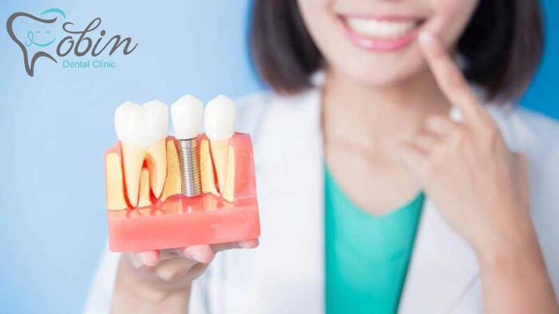 میانگین طول عمر یک ایمپلنت دندان